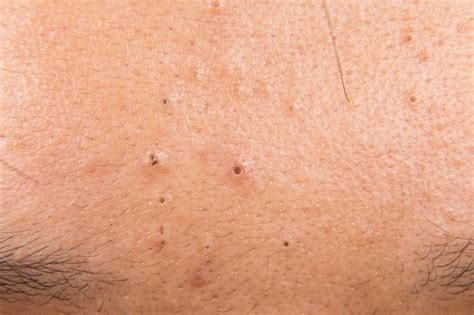 How To Naturally Get Rid Of Blackheads Livestrongcom
