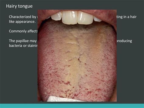 White Lesions Of Oral Cavity