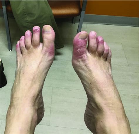 Erythematous Patches Of The Toes With Edema And Some Overlying Scale