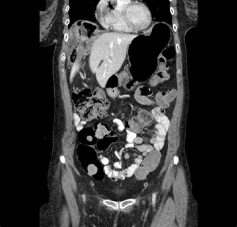 Does An Abdominal Ct Scan Show The Colon Ct Scan Machine