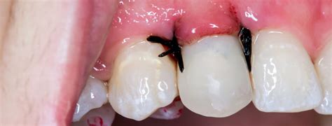 Image supplied by picture alliance angst vorm bohren ist häufig ein grund, regelmäßige zahnvorsorgetermine nicht wahrzunehmen. MOOCI. Zahntransplantation: Lückenfreies Gebiss!