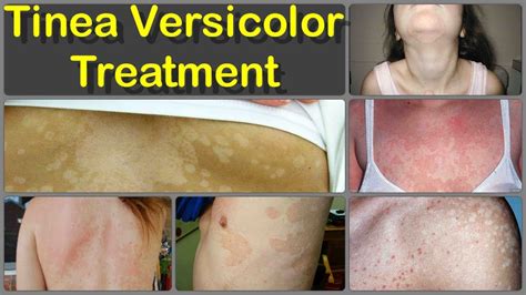 Home Remes To Treat Pityriasis Versicolor Homemade Ftempo
