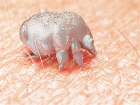 Illustration Of A Scabies Mite On Human Skin Photograph By Sebastian