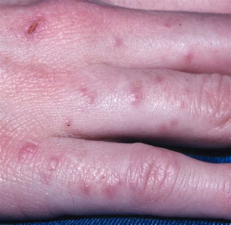 Scabies On Hands Pictures Photos