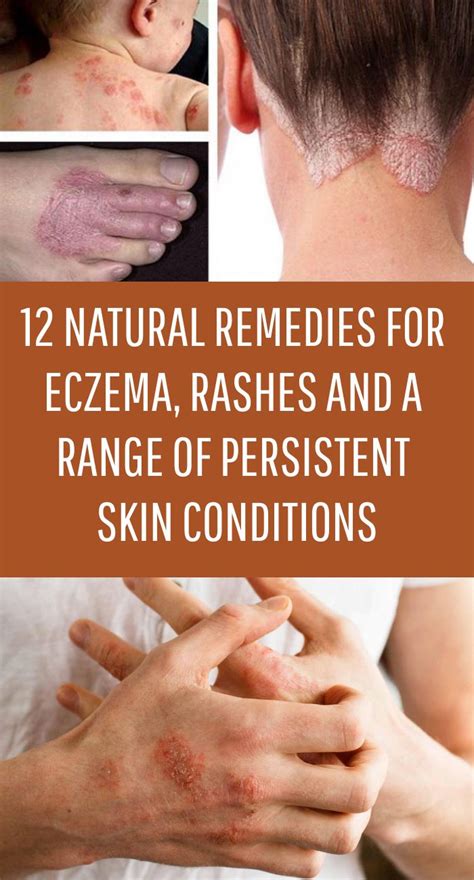 12 Natural Remedies For Eczema Rashes And A Range Of Persistent Skin Conditions In 2021