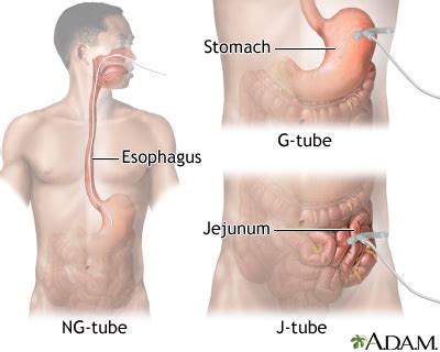 Tube Feeding Medlineplus Medical Encyclopedia Image
