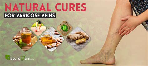 10 Natural Cures For Varicose Veins Treat Varicose Veins Naturally