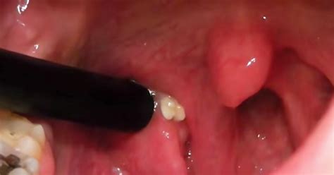 Tonsil Stones Symptoms And 10 Home Natural Treatments David Avocado Wolfe