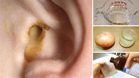 How To Cure An Ear Infection Naturally At Home Youtube
