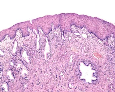 Endocervix Humano Metaplasia Escamosa Foto De Archivo Imagen De Epitelial Hembra