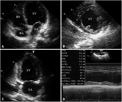 Two Dimensional Transthoracic Echocardiography Follow Up Download