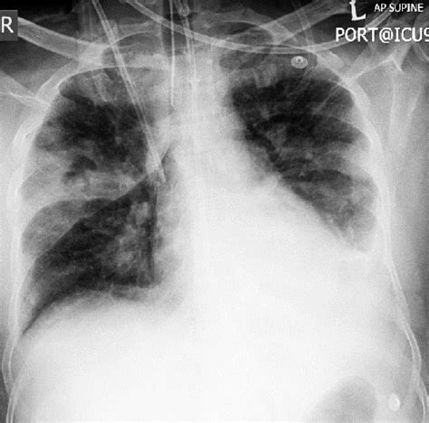 Pleural Effusion With Lung Changes Ggo Consolidation And Fibrotic