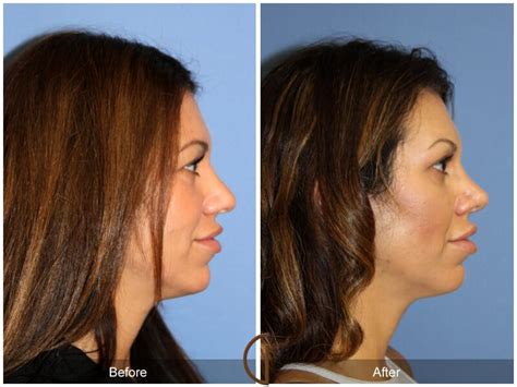 Female Rhinoplasty Before And After Photos Patient 02 Dr Kevin Sadati