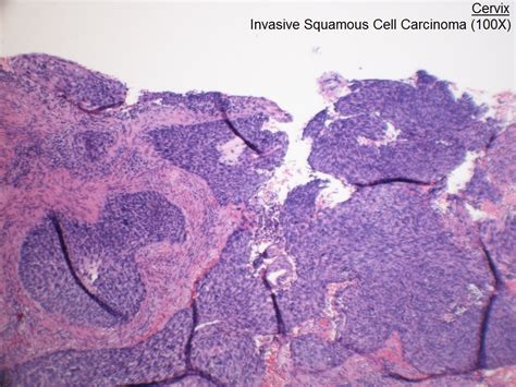B Cervix Invasive Squamous Cell Carcinoma 100x
