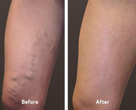 Difference Between Superficial And Deep Veins Vein Clinics Of America Varicose Veins Treatment
