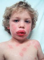 Ü80% of patients with duodenal ulcers, h pylori is present. Anaphylactic Shock and Acute Allergic Reaction - First Aid ...