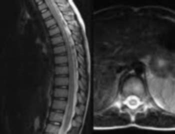Transverse myelitis is an inflammation of both sides of one section of the spinal cord. Transverse myelitis | Cerebral