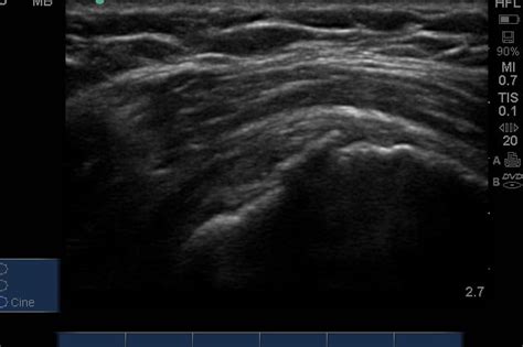 Acromioclavicular Joint Osteolysis