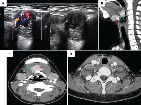 Frontiers Diagnosis And Treatment Of Ectopic Thyroid Carcinoma A