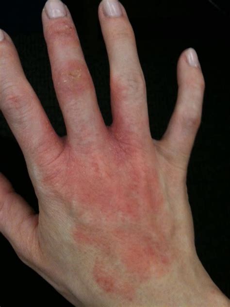 Eczema Skin Rash On Hands Sexiezpix Web Porn
