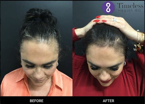 PRP Hair Restoration - West Covina, CA: Timeless Health MD