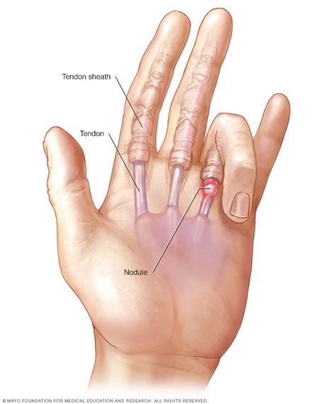 Trigger Finger Disease Reference Guide