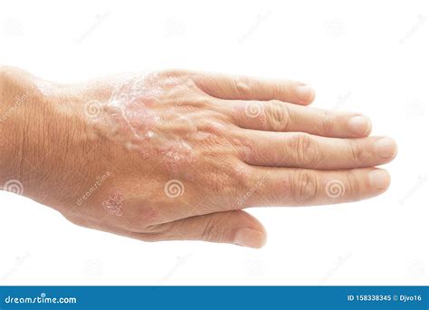 Psoriasis Vulgaris And Fungus On The Man Hand With Plaque Rash And