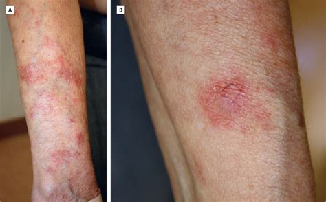 Subacute Cutaneous Lupus Erythematosus Dermatology Jama Dermatology The Jama Network