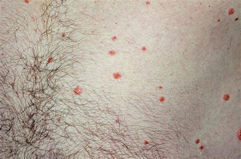 Guttate Psoriasis On The Body Photograph By Dr P Marazziscience Photo