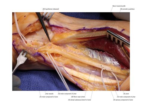 Anterior Interosseous To Ulnar Motor Nerve Transfer Surgical