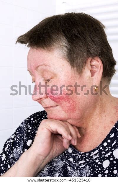 Elderly Woman Rosacea Facial Skin Disorder Stock Photo 451523410