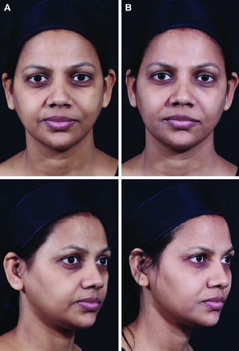Skin Treatment Before And After India Your Magazine Lite