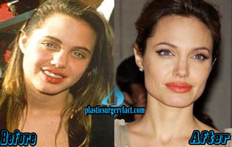 Angelina Jolie Plastic Surgery Before And After Photos