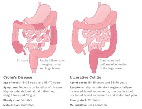 Resumen De La Enfermedad De Crohn Crohns And Colitis Foundation