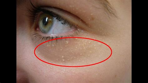 Miracle Meaning On Your Little White Spots On Your Face Youtube