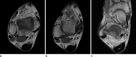 Figure 1 From The Value Of Mri In Idiopathic Tarsal Tunnel Syndrome By