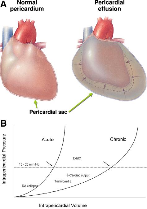 Cardiac Tamponade Vs Pericardial Effusion What Re The Major Differences