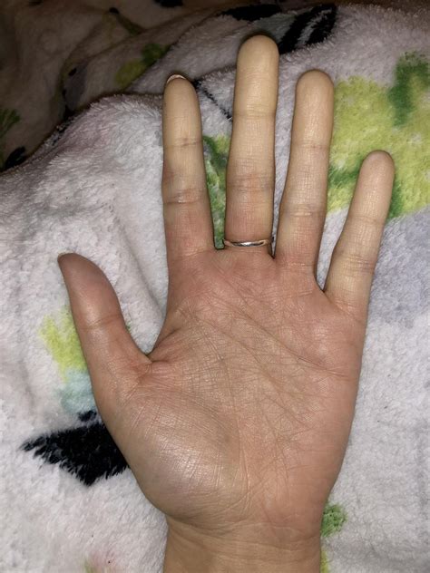 Album Of My Reynauds Phenomenon To Show That Its Not Just About Hands Feeling Cold Or Numb