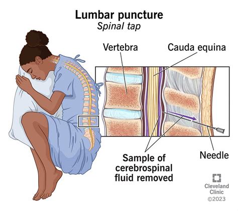 Lumbar Puncture Spinal Tap What It Is Purpose And Procedure
