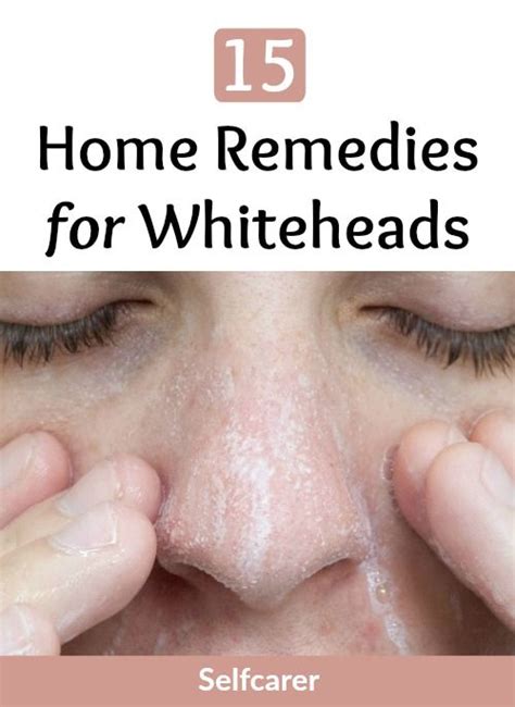 15 Home Remedies For Whiteheads Selfcarer Whiteheads Remedy Skin