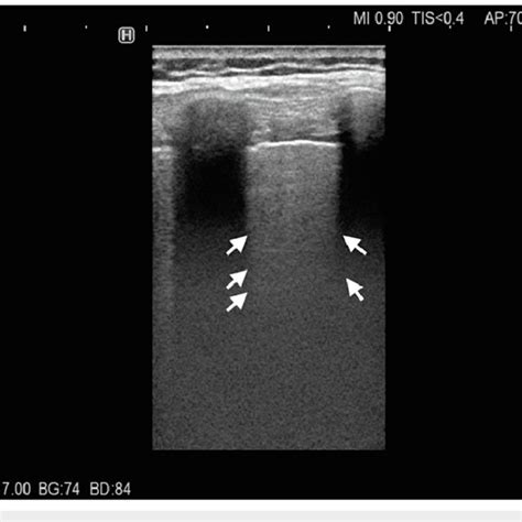 Lung Ultrasound Of The Left Lower Posterior Zone Plaps Point The
