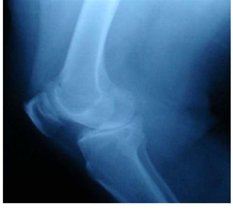 Lateral Radiograph Of Right Knee Download Scientific Diagram