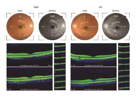 Fundus Photographs And Optical Coherence Tomographic Image Of Both Eyes