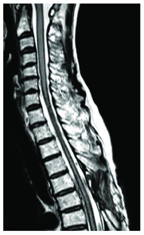 T2 Weighted Mri Of The Cervical To Upper Thoracic Spine Taken Three
