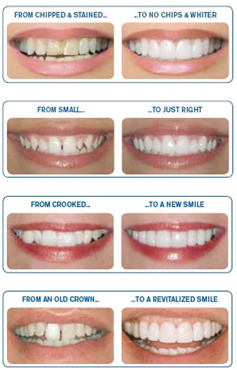 Diy veneers, on the other hand, usually consist of one solid removable plastic piece that fits right over your existing teeth and covers them up from molar to molar. Pin on Veneers