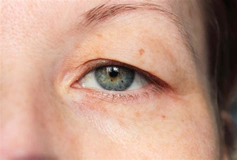 Drooping Eyes Causes Symptoms And Treatment Auckland Nz Palm Clinic