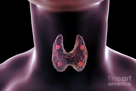 Parathyroid Glands Photograph By Kateryna Konscience Photo Library