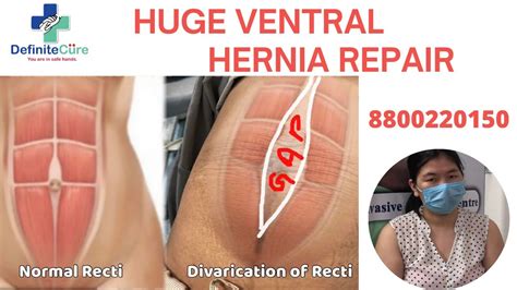 Ventral Hernia Surgery Ventral Hernia Incisionalhernia Youtube