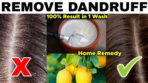 How To Cure Dandruff Permanently Men How To Treat Dandruff Curd