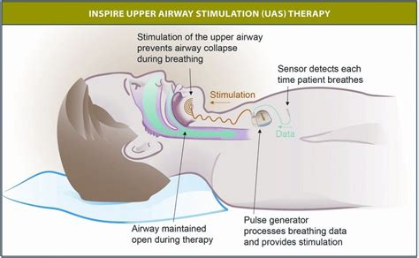 Experimental Shock Therapy Offers Hope For Sleep Apnea Sufferers